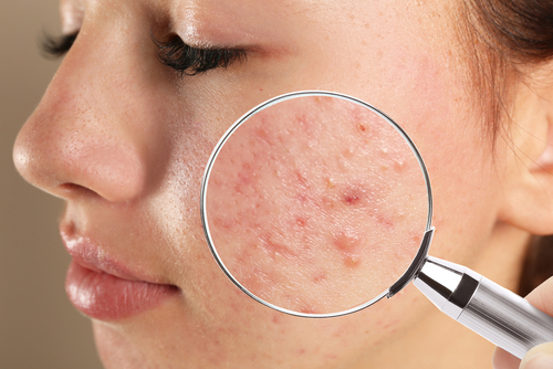 Acne in Mesa, Sun City, Casa Grande, Gold Canyon, & Chandler, AZ